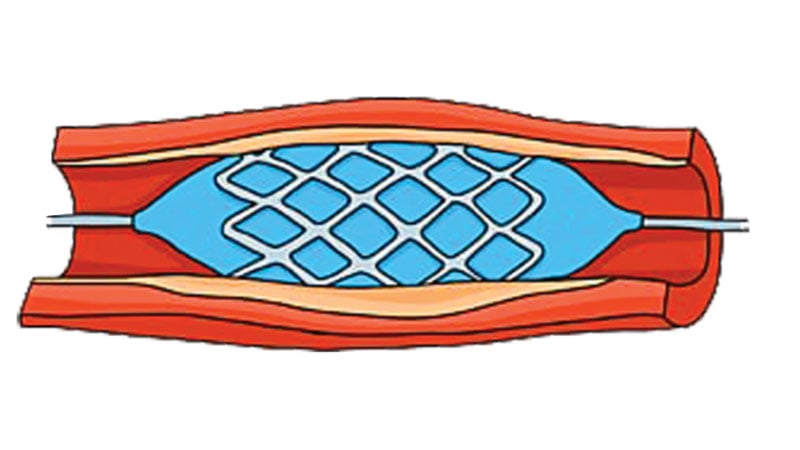 হার্টের অবৈধ রিং ব্যবসা, জড়িত চিকিৎসক-নার্স